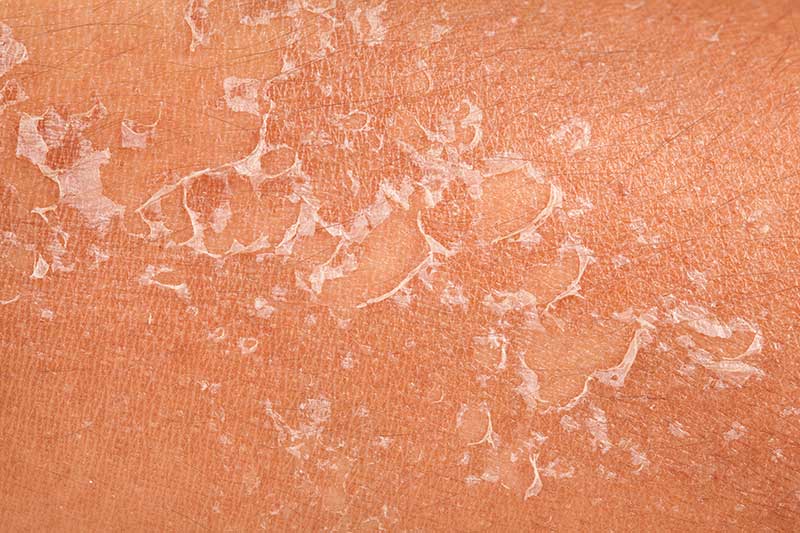 Effective Solutions For Sunburn